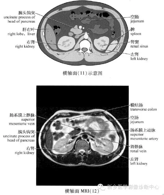史上最全腹部横断位解剖详细标注