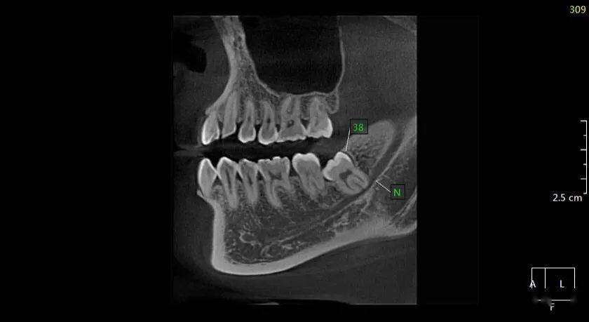 孫xx20210424智齒cbct158xxxx2993