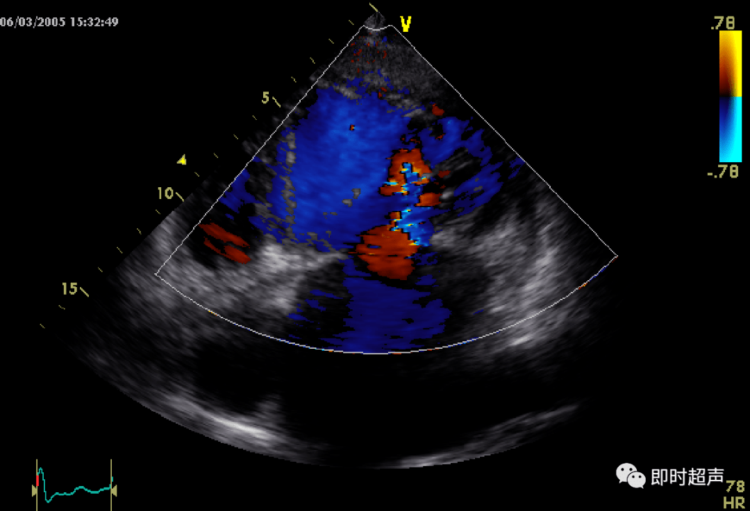 心臟瓣膜病超聲診斷_二尖瓣