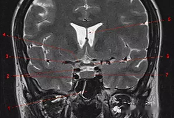 鞍区,垂体磁共振(mri)解剖——冠状面