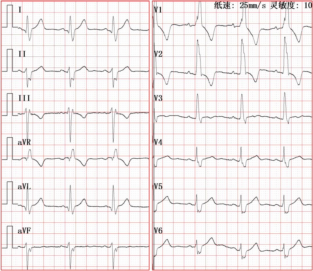 右束支阻滞合并其他心电异常如何识别进阶篇
