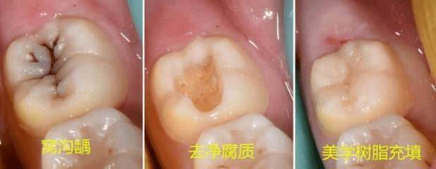 牙齿上出现了黑线别慌这样做就可以了