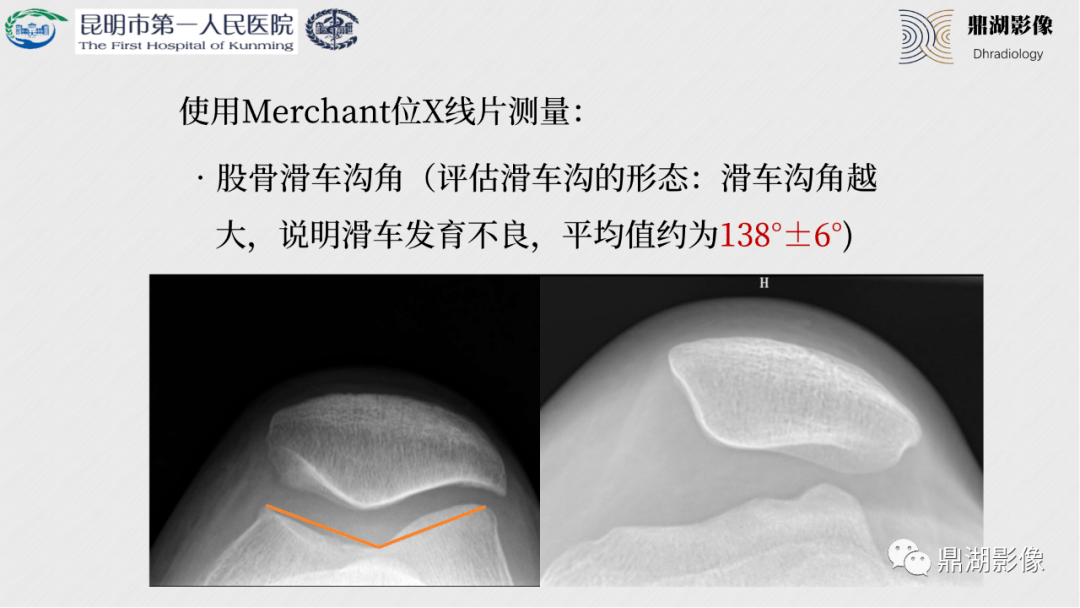 如何拍出完美的膝关节x线片这些经验太重要了