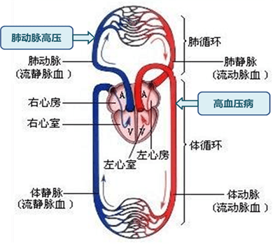 肺腑之言|认识肺动脉高压,关爱"蓝唇人"_疾病