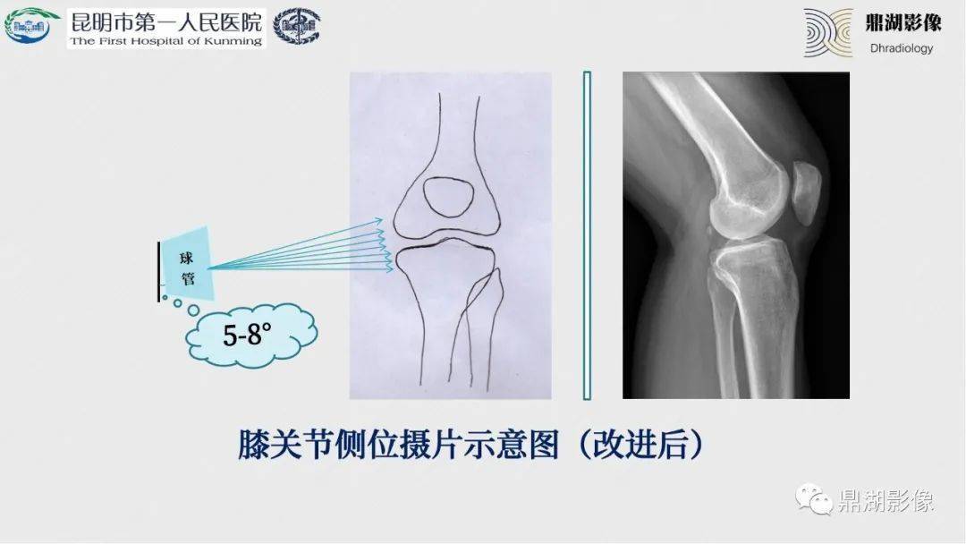 如何拍出完美的膝关节x线片这些经验太重要了