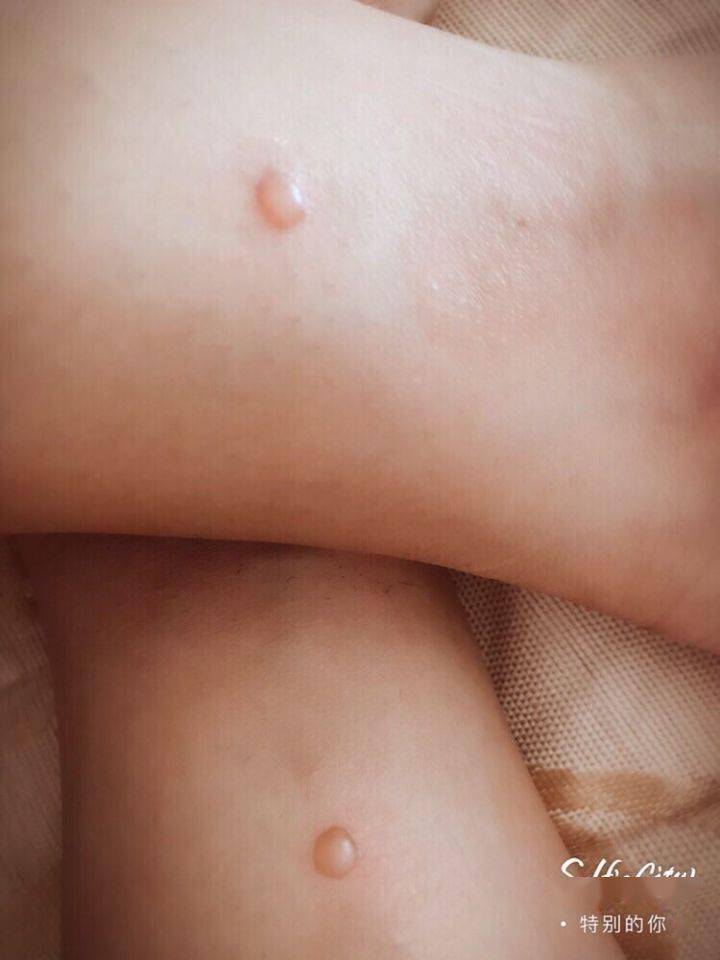 灸花是灸法术语,也叫"灸疮".