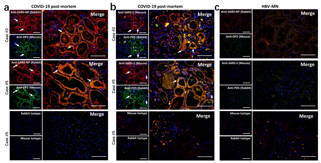 我国学者证实:新冠病毒能直接感染肾脏,导致急性肾损伤