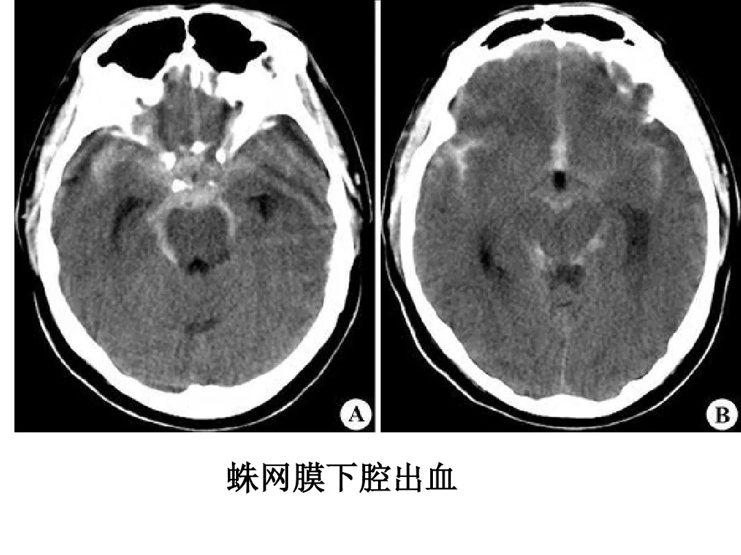 影像总结头颅ct基本知识与常见病变
