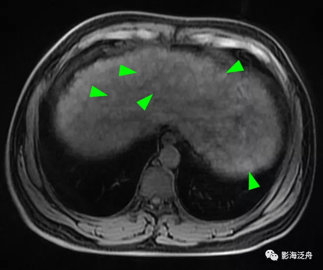 肝脏弥漫性病变的诊断