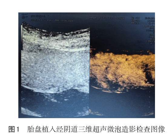 575 经阴道三维超声微泡造影与增强磁共振对胎盘前置状态中孕引产患者