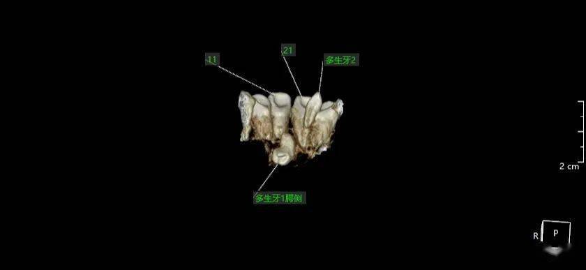 张凯瑞20210515多生牙cbct