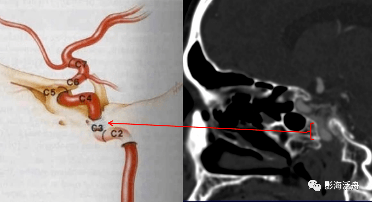 【超实用】今天学会颈内动脉cta分段