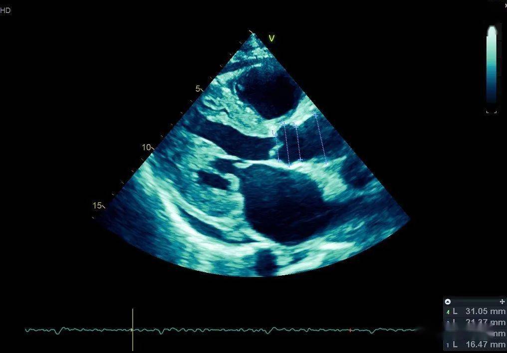 真假肥厚心考验超声医生是否练就火眼金睛的时刻到了