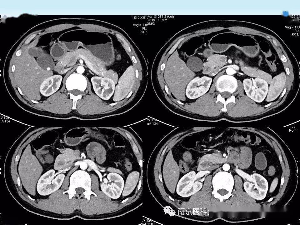 胰腺ct断层解剖图片