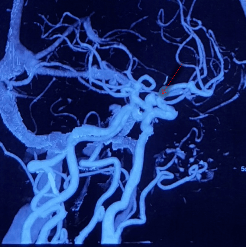 沛嘉加奇嘉介谈丨苏万东tethys03中间导引导管在颈内眼动脉段动脉瘤