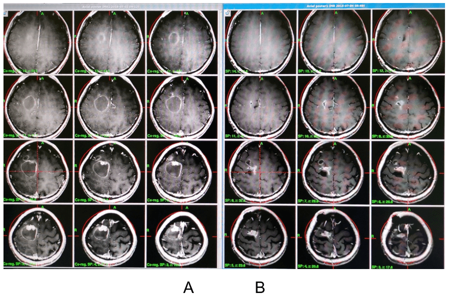 研究孙君昭张剑宁立体定向ommaya囊植入联合伽玛刀治疗颅内大型囊性