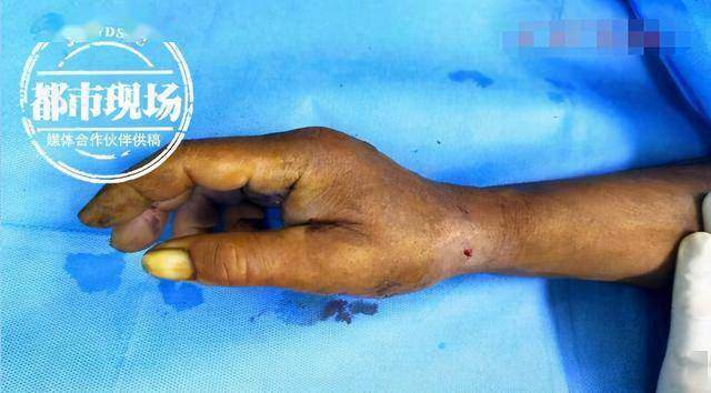 刘双阳:两头都看不到了,只看到鱼镖的尖体,很小很小,两三毫米长的尖体