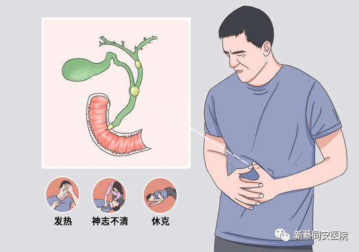 同安一招鲜腹腔镜联合输尿管硬镜治疗小黄人梗阻性胆总管结石