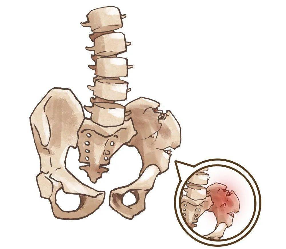 人生最后一次骨折?九旬老人髋关节置换后又能走路了