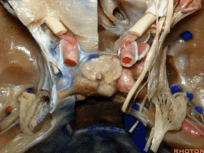 oftentimes these carotids bulge into and indent the lateral side