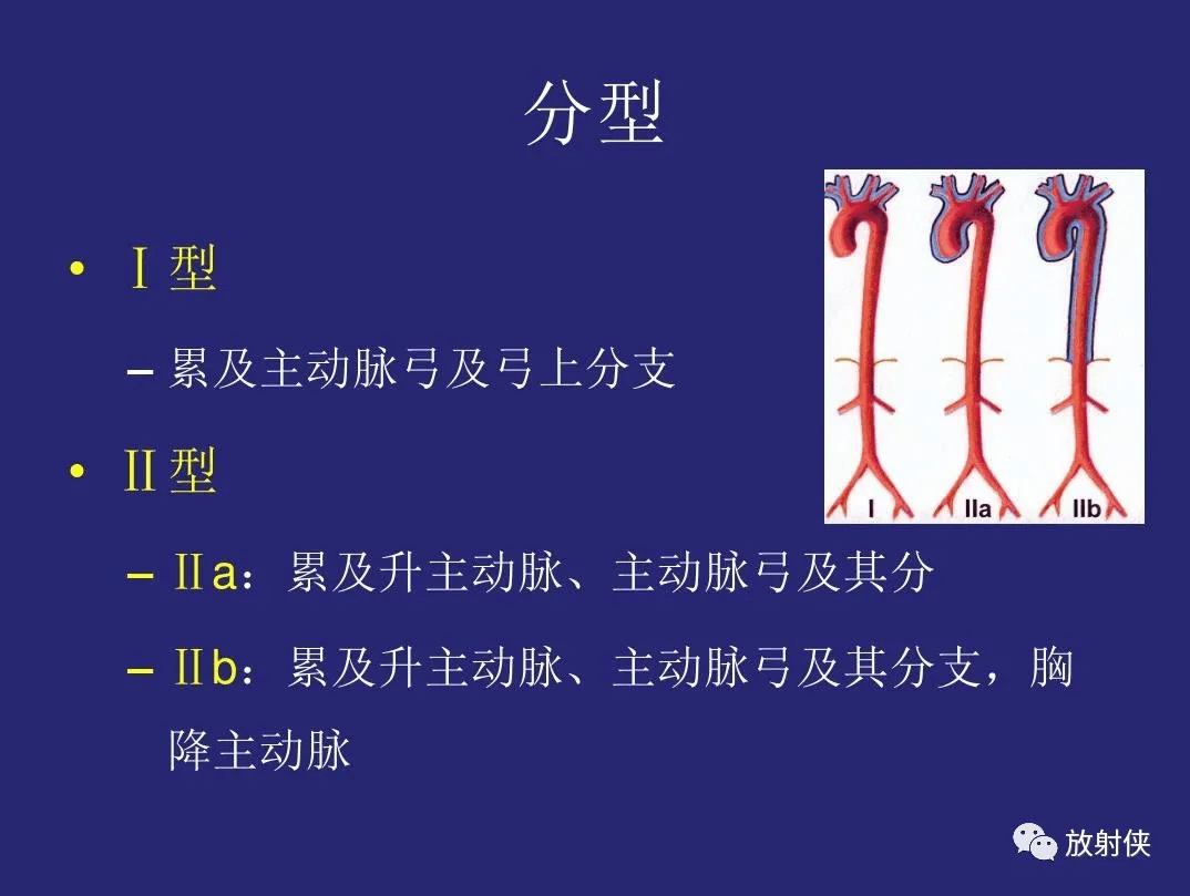 精品大动脉炎分型及ct诊断