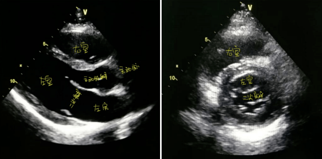 心脏超声报告不会看先熟记这6大指标