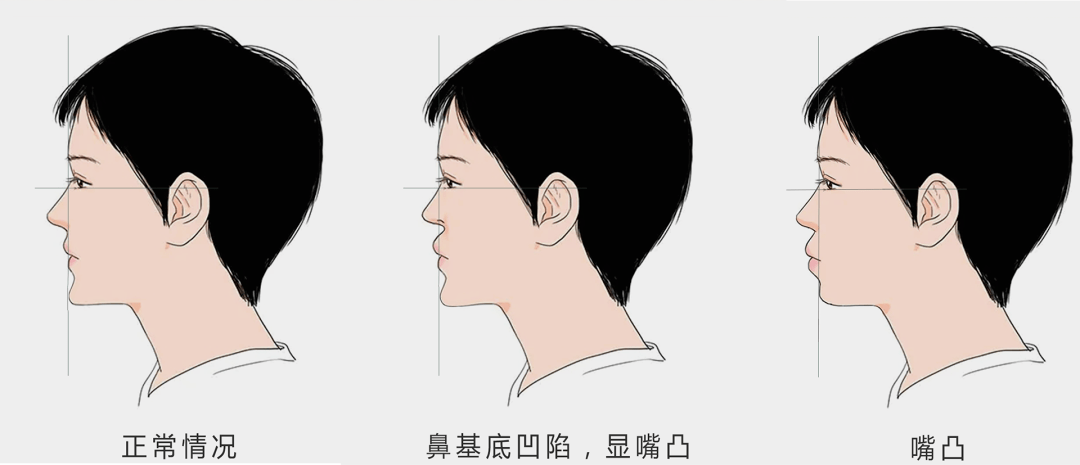 干货鼻基底到底要不要做材料该怎么选