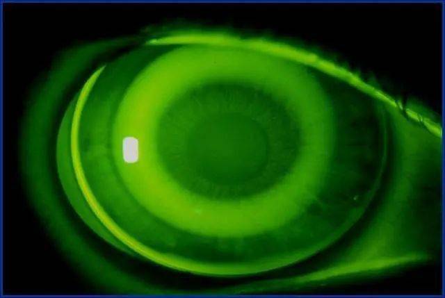 孩子在戴角膜塑形镜,总是担心戴镜进气泡怎么办?_镜片