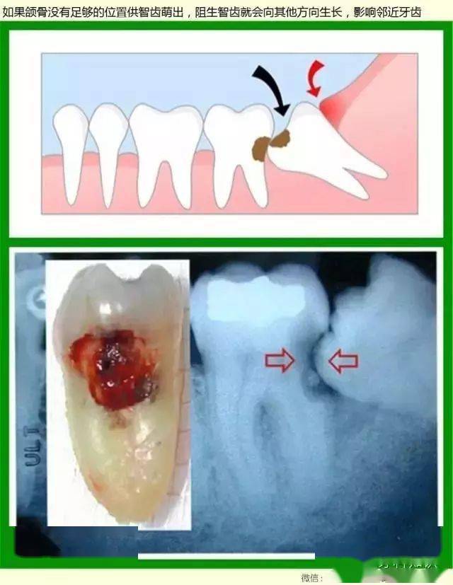 什么样的智齿一定要拔?专业牙医告诉您