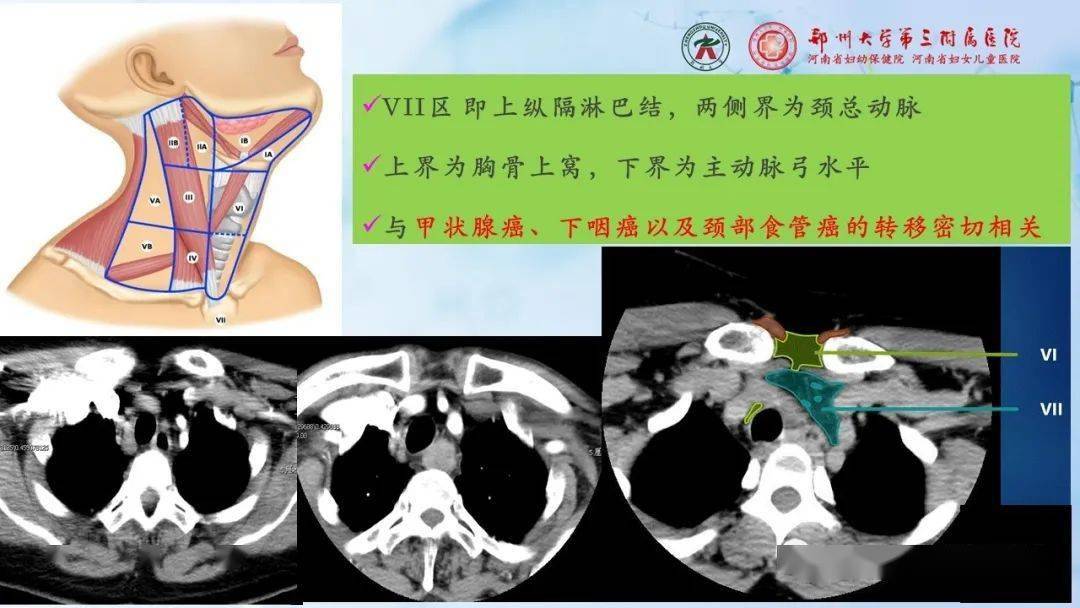 頸部淋巴結的分區及常見病變影像表現