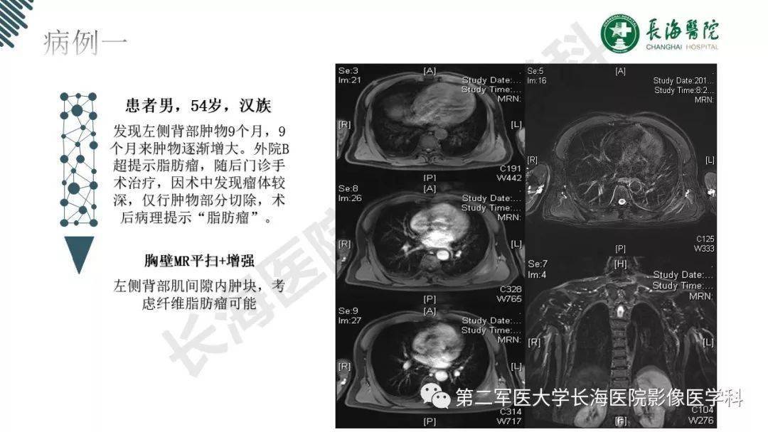 彈力纖維瘤的影像診斷