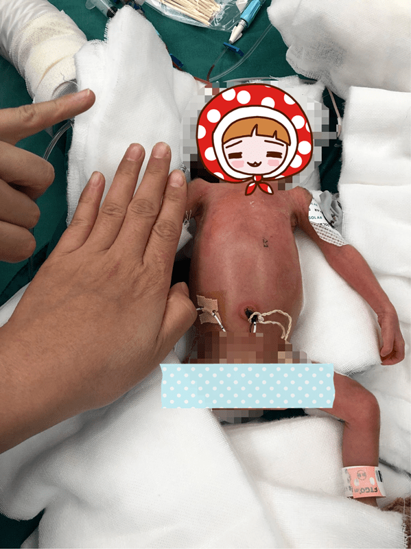 720克低体重,坏死性小肠结肠炎新生儿在我院获救