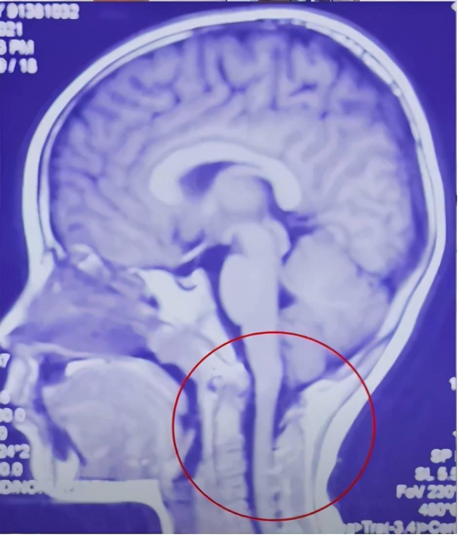 儿童出现小脑扁桃体下疝可以靠保守治疗恢复吗