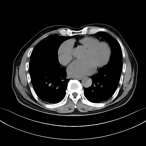 经典图谱ct平扫诊断主动脉夹层