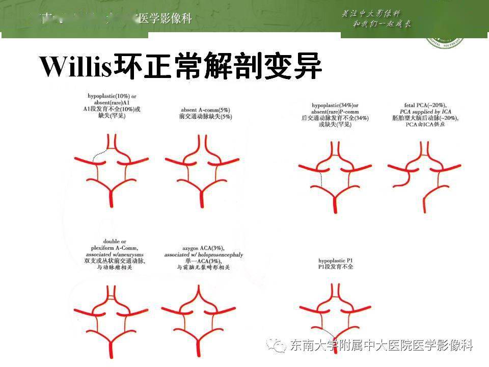 超全讲解头部血管解剖及wills环常见变异