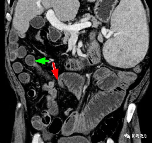 这个病,腹部ct经常会漏诊