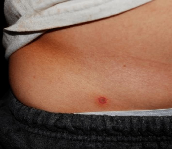 小蜱虫,大威胁,科学防蜱很重要!_皮肤