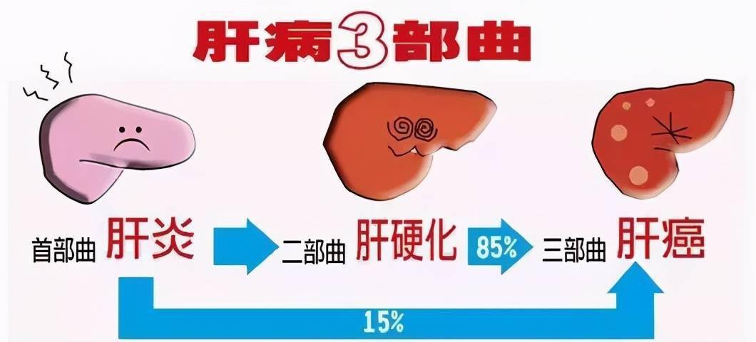 肝炎肝硬化肝癌是三部曲我们该如何科学应对请看此文