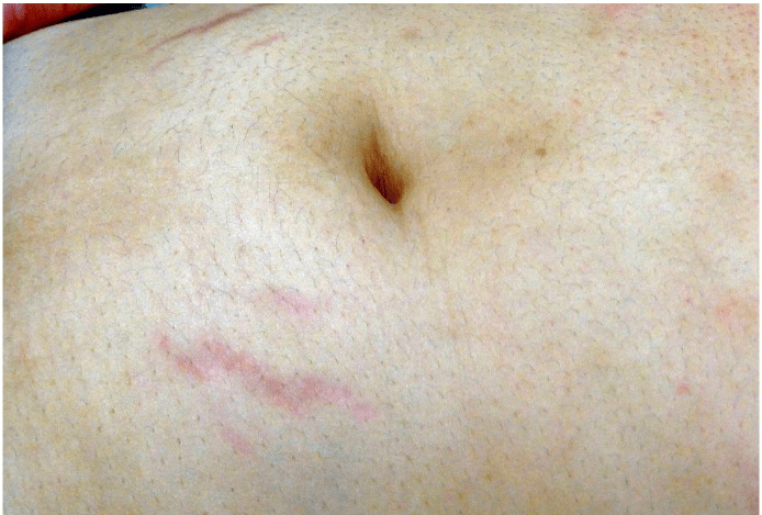 胸上面的妊娠纹图片图片