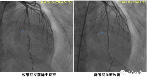 左前降支中段心肌桥图片