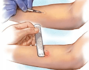 目前我院使用的头孢菌素类仅注射用头孢噻肟钠说明书中注明"用药前需