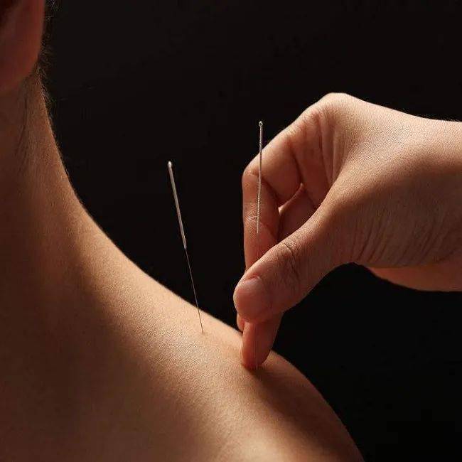 夏至养生 | 博鳌一龄中医理疗帮您调养精神,舒心过夏_针灸