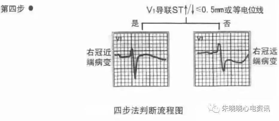 急性正后壁心肌梗死心电图