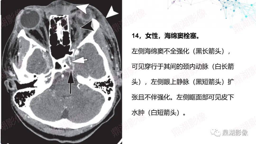头颈部CTA解剖图谱图片