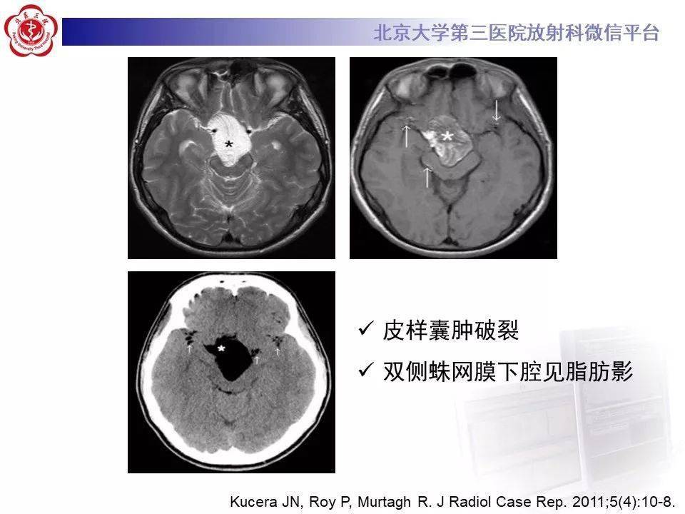 颅内畸胎瘤影像诊断与鉴别