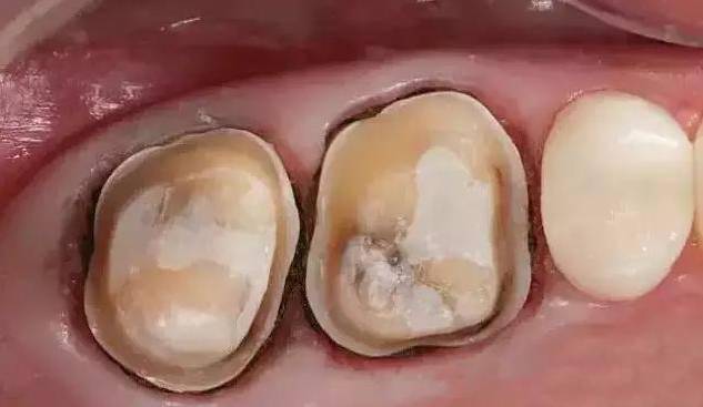 牙冠边缘不密合与咬合高主要原因在哪里你知道吗