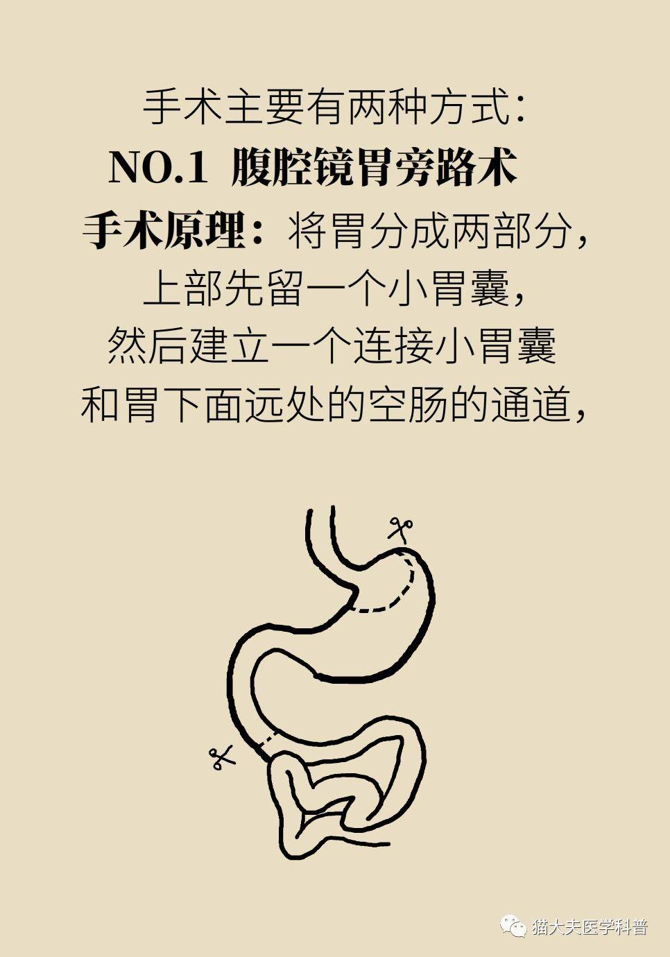 腹腔镜|什么样的人能做减重手术？专家：符合这个指标才行