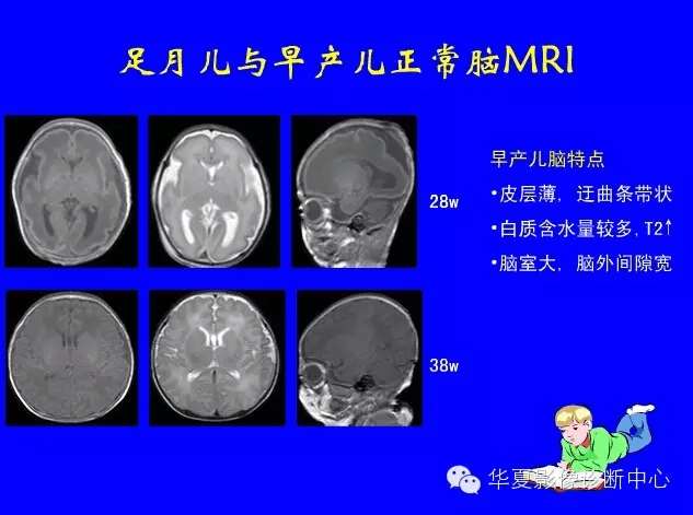 最全新生儿颅脑mri诊断工作必备大家看过来