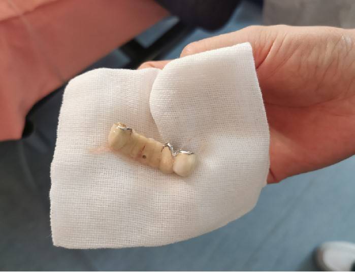 支气管|成排假牙掉进气道，肿瘤堵塞支气管……支气管镜开路悉数疏浚