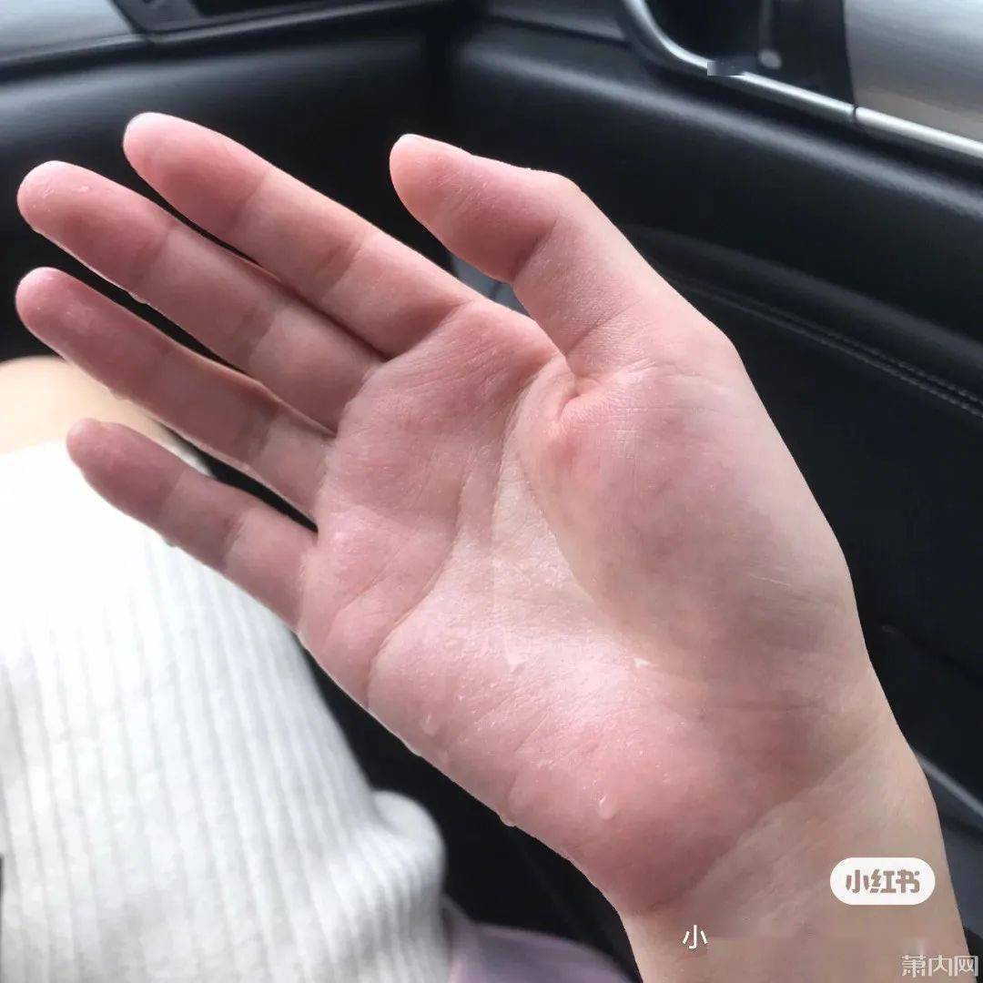 交感神经|萧山姑娘这个尴尬多年的病症，终于下决心做了手术！经历值得一看